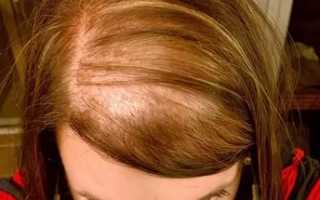 Что такое диффузное выпадение волос (диффузная алопеция) и как его лечить?