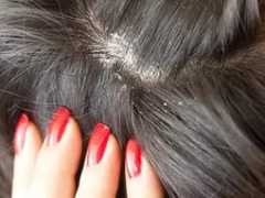 Сухая кожа головы и сильное выпадение волос: витамины, какой шампунь поможет?