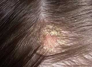 Себорейное выпадение волос: симптомы и лечение