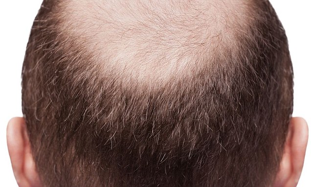 Заболевания кожи головы при которых выпадают волосы