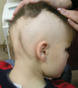 Гнездовое выпадение волос у детей