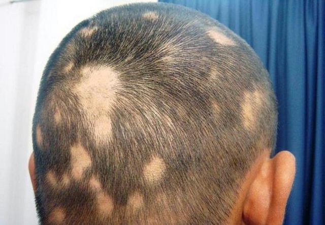 Заболевания кожи головы при которых выпадают волосы