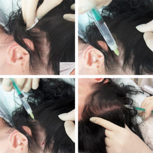 Мезотерапия при выпадении волос у мужчин