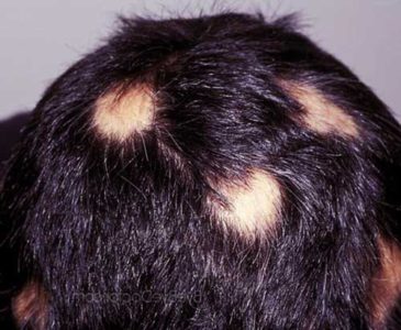 Очаговое выпадение волос у ребенка причины