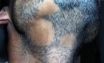 Алопеция на бороде у мужчин причины возникновения
